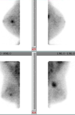 A 53-year-old woman with a new diagnosis of IDC presented with a left upper outer quadrant breast lump. BSGI clarified the extent of the lump (lower right image) and found a previously undiscovered tumor (upper left image). Image courtesy of Dr. Marie Tartar.