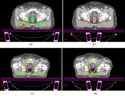 Representative Imrt And Rapid Arc Dose Differences Between The Different Scenarios