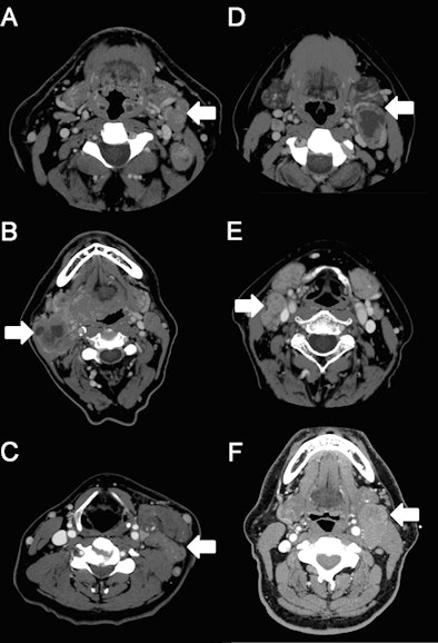 Ct Scans Showing Matted And Nonmatted Nodes