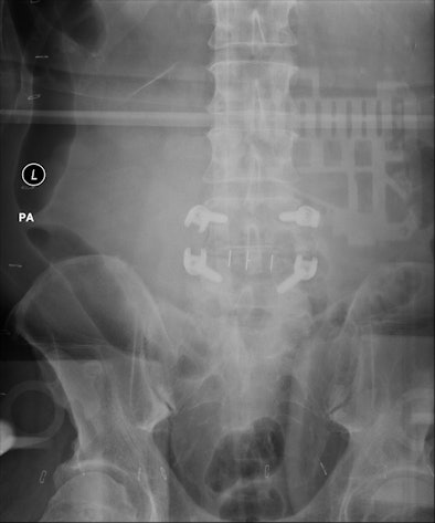 Backscatter Artifact Expressed Itself As An Outline Of Dr System Electronics Imposed On High Exposure Images Of Large Patients Or Long Exposures