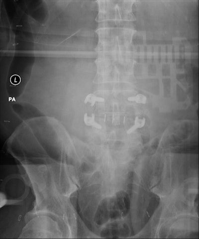 Backscatter Artifact Expressed Itself As An Outline Of Dr System Electronics Imposed On High Exposure Images Of Large Patients Or Long Exposures