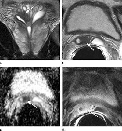 The Surgical Plan For This 53 Year Old Man Was Changed To A Non Nerve Sparing Technique After Review Of Mr Images