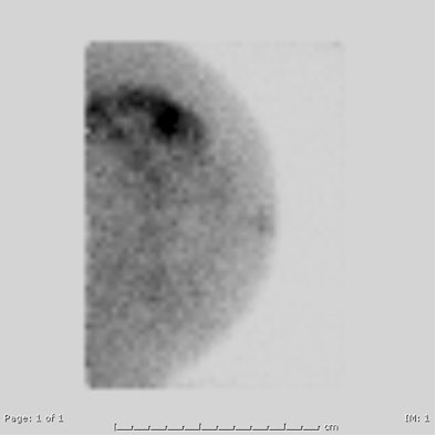 The Bsgi Image Uncovers A Much Larger Extent Of Disease Than The Mammogram