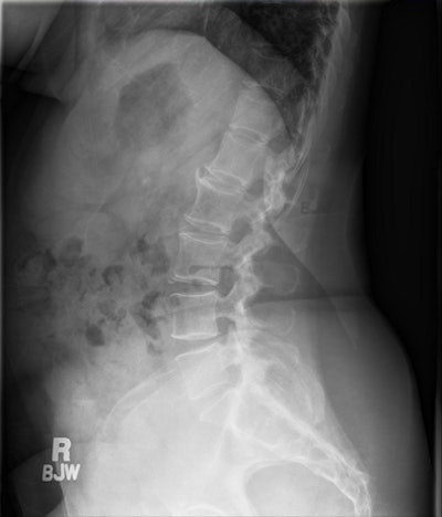 Outline Of The Patient's Neckline And Lead Marker From A Swimmer's View Of A Shoulder Study Are Seen In This Lumbar Spine Image Taken Two Minutes Later