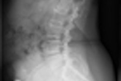 2012 02 02 13 29 01 787 Lumbar Ghosting Image Thumb