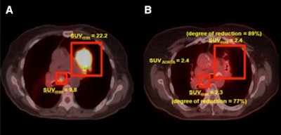 Pet/Ct Scans Of Fdg Uptake Before And After Radiation Therapy