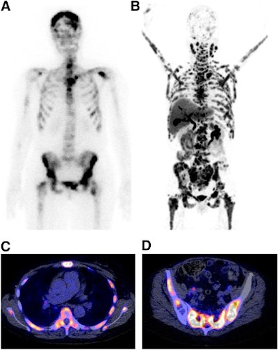 Bone Scan, Fes Pet, And Fes Pet/Ct Images Of A Patient With Progressive Disease After Multiple Lines Of Therapy