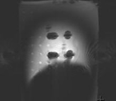 Excessive Signal Void Was Associated With The Armor Piercing Bullet (no 32)