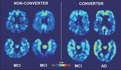 Baseline And Follow Up Scans Of One Patient Who Developed Alzheimer's And A Second One Who Did Not