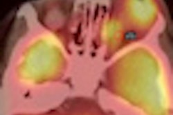 2012 02 14 10 23 14 446 Jnm Retinoblastoma Thumb