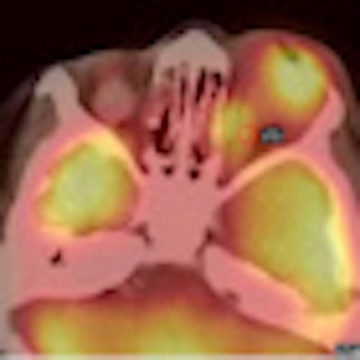 2012 02 14 10 23 14 446 Jnm Retinoblastoma Thumb