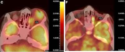 After Three Cycles Of Neoadjuvant Chemotherapy, Pet/Ct Image Shows Decrease In Size Of Left Orbital Tumor And Optic Nerve Uptake