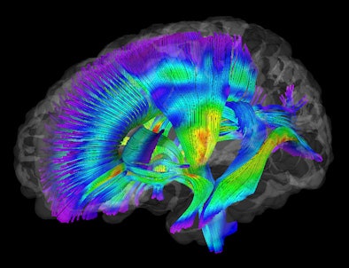 White Matter Pathways Extracted From Dti Mri For Infants At Risk Of Developing Autism