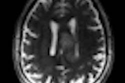 2012 02 22 11 14 42 686 Glioblastoma T2