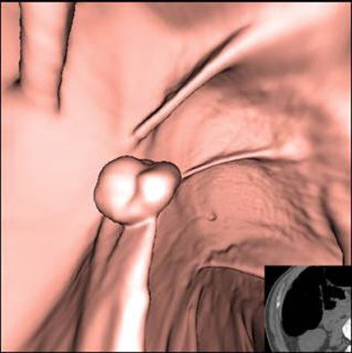 Ctc Endoluminal Image Of A 1 Cm Polyp Attached To A Colonic Fold In The Ascending Colon