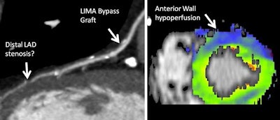 CT coronary angiography of 65-year-old male patient with new onset of angina pectoris and status post-bypass surgery. The static, morphologic CT angiography (left) shows a patent left internal mammarian artery (LIMA) bypass to the left anterior descending artery (LAD), but a potential stenosis in the LAD distal to the bypass insertion, with unknown significance or relevance. The dynamic, time-resolved CT perfusion image (right) under adenosine stress shows a hypoperfusion in the LAD territory (anterior wall), proving the hemodynamic relevance of this stenosis. Images courtesy of Dr. Konstantin Nikolaou.
