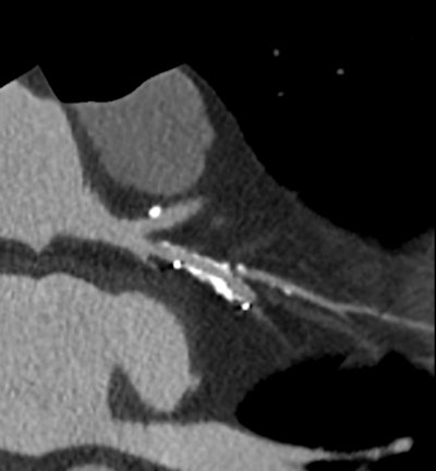 High-definition cardiac CT image obtained on GE Healthcare's Discovery CT750 HD shows stenosis adjacent to stent. (Provided by GE)