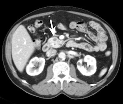 Axial contrast-enhanced CT scan during the pancreatic phase of the dynamic study shows a hypodense lesion in the head of the pancreas (arrow), representing a small adenocarcinoma at surgico-pathological examination. All images courtesy of Dr. Riccardo Manfredi.