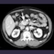 2012 02 27 16 50 42 366 2012 03 01 Pancreas Thumb