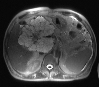 Serous cystadenoma: Axial half-Fourier T2-weighted image (TR/TE ∞/120 msec) shows a multicystic, microcystic neoplasm of the head of the pancreas with a central scar.