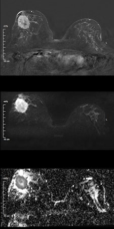 Invasive ductal carcinoma. Top: Early contrast-enhanced T1-weighted subtraction image depicting a large mass lesion in the right breast. Middle: Diffusion-weighted image at b = 1000 s/mm2 shows high signal corresponding to the contrast enhancement in the first image. However, in this case, the signal is due to restricted diffusion, meaning that no external contrast agent was used. Bottom: Quantitative parametric diffusivity map of apparent diffusion coefficient (ADC) values. Dark pixels correspond to restricted diffusion, while bright pixels correspond to increased diffusion. In the outer part of the tumor, dense clusters of cancer cells cause restricted diffusion; the diffusion measured by DWI is mainly caused by extracellular diffusion. Clearly, diffusivity is elevated inside the center of the lesion, corresponding to necrosis, which is indicative of a very aggressive cancer. All images courtesy of Dr. Pascal Baltzer.