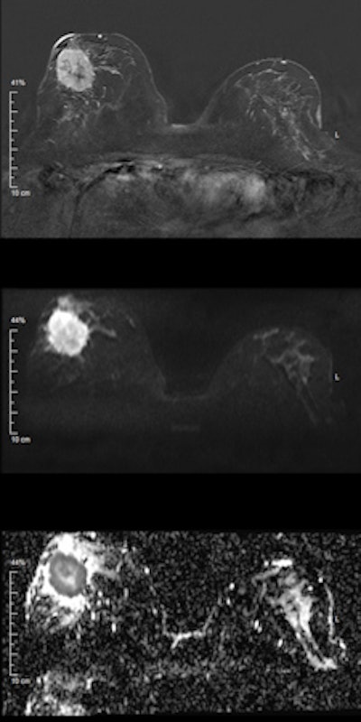 Invasive ductal carcinoma. Top: Early contrast-enhanced T1-weighted subtraction image depicting a large mass lesion in the right breast. Middle: Diffusion-weighted image at b = 1000 s/mm2 shows high signal corresponding to the contrast enhancement in the first image. However, in this case, the signal is due to restricted diffusion, meaning that no external contrast agent was used. Bottom: Quantitative parametric diffusivity map of apparent diffusion coefficient (ADC) values. Dark pixels correspond to restricted diffusion, while bright pixels correspond to increased diffusion. In the outer part of the tumor, dense clusters of cancer cells cause restricted diffusion; the diffusion measured by DWI is mainly caused by extracellular diffusion. Clearly, diffusivity is elevated inside the center of the lesion, corresponding to necrosis, which is indicative of a very aggressive cancer. All images courtesy of Dr. Pascal Baltzer.