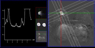 A single-voxel 1.5-tesla spectroscopy image of an invasive lobular carcinoma. The left image depicts the spectrum, i.e., the chemical components of the cancer, and the peak in the middle at about 3.23 ppm is due to tumor-specific choline metabolites. The right image shows the measurement voxel inside a contrast-enhancing mass (the cancer).