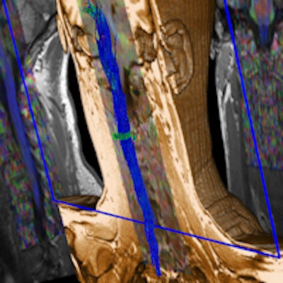 Diffusion tensor imaging (DTI) tractography evaluation in the C-spine. Syngo DTI tractography uses diffusion tensor data and allows 3D visualization of specific white-matter tracts, e.g., to determine the location of the corticospinal tract or the thalamocortical tract. (Provided by Siemens)
