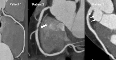 2012 02 28 18 17 52 827 Coronary Cta 450