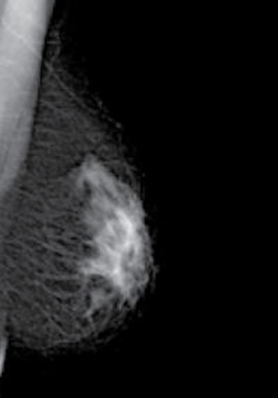 The photon-counting technology used by MicroDose allows for single-shot spectral image acquisition, which is currently under development. (Provided by Philips)