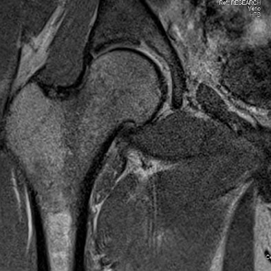 3 Tesla Coronal Mr Image Shows A Superolateral Acetabular Labral Tear