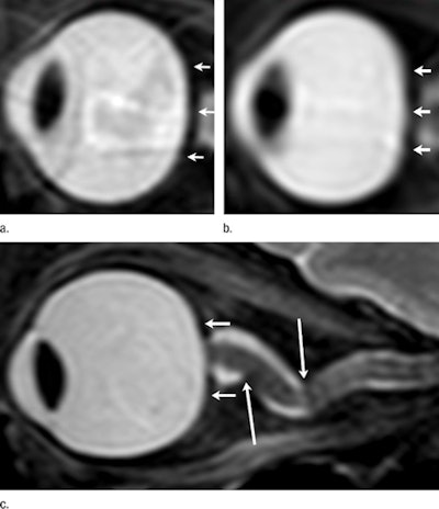 Left Eye Before Long Term Exposure To Microgravity, And Left And Right Eye After Long Term Exposure