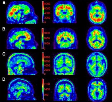 Florbetapir Images For 111 M Bq And 370 M Bq Dose Groups
