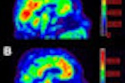 2012 03 14 16 59 38 548 Florbetapir Pet Amyloid Thumb