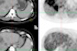 2012 03 16 14 11 22 443 Pet Ct Liver Metastases Thumb