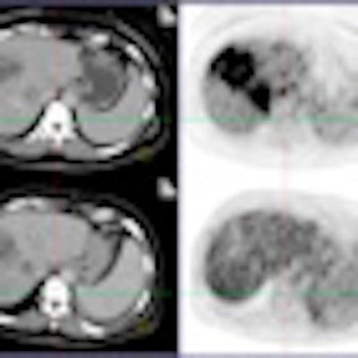 2012 03 16 14 11 22 443 Pet Ct Liver Metastases Thumb