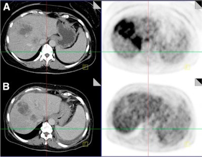 Ct Images, Left, And Fused Pet/Ct Images, Right