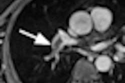 2012 03 16 15 49 18 499 Pulmonary Embolism Thumb