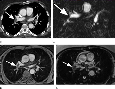 Pulmonary Embolus (arrow) Of The Right Pulmonary Artery In A 67 Year Old Woman