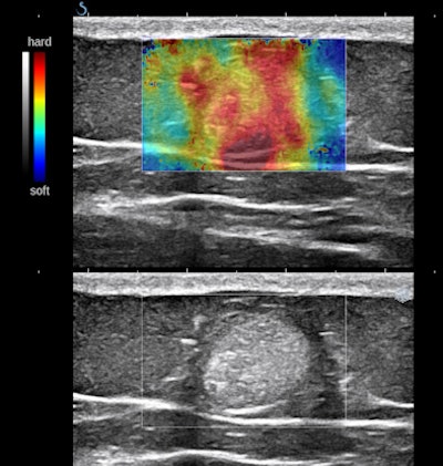 Solid mass of mixed histology at ultrasound