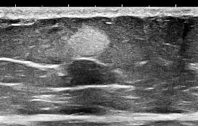 Ultrasound of abdominal wall