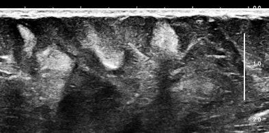 Ultrasound of anterior abdominal wall