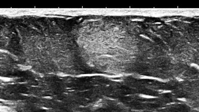 Ultrasound of anterior abdominal wall