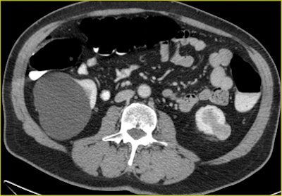 CTC after incomplete colonoscopy at the transverse colon