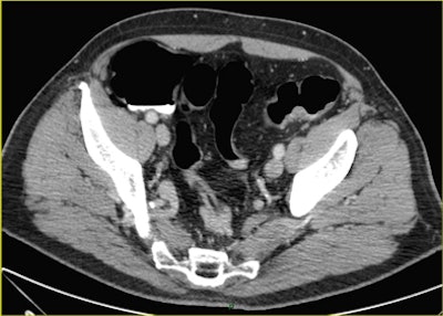 CTC after incomplete colonoscopy at the transverse colon