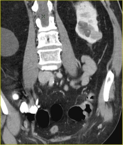 CTC after incomplete colonoscopy at the transverse colon