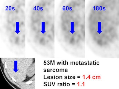 metastatic sarcoma in liver