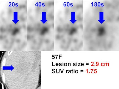 2.9-cm liver metastasis