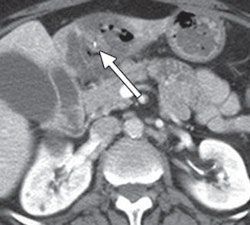CT scan of bristle