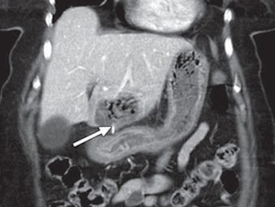 liver CT scan bristle